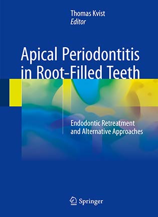 Апикальный периодонтит в корне зубов