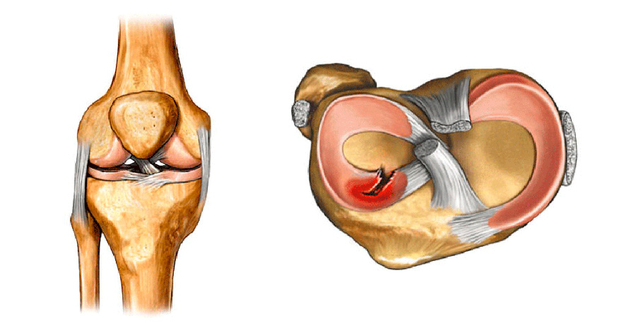 Мениск колена - как вылечить без операции?