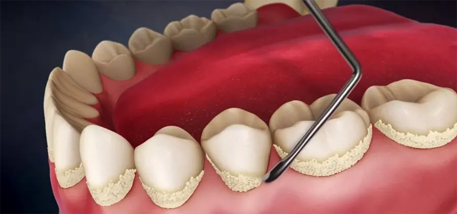 Зубной камень - причины, симптомы, профилактика. Как удалить зубной камень?