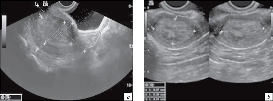 Визуализация и размеры органа по данным УЗИ при раке шейки матки (a) и раке тела матки (b)