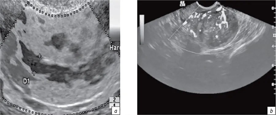 Визуализация зон интереса и оценка кровотока органа по данным эластографии (a), интенсивности кровотока по данным УЗИ (b) при раке тела матки