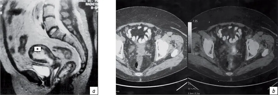 Визуализация полости матки (*), контрастированного мочевого пузыря и толстой кишки по данным МРТ (а); рецидива рака шейки матки по данным ПЭТ-КТ (b)