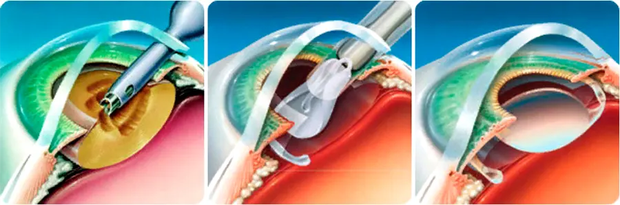 Операция - единственный способ успешно вылечить катаракту