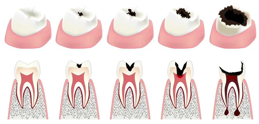 Кариес: как позаботиться о здоровье зубов