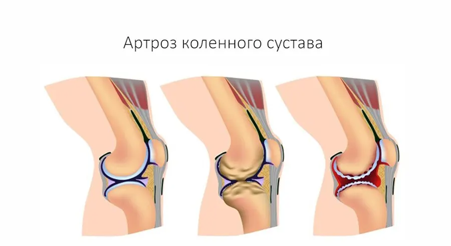 Артроз коленного сустава - симптомы, лечение