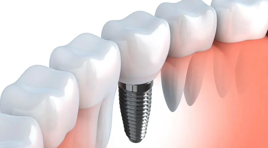 Имплантация зубов: естественность и функциональность зубного ряда