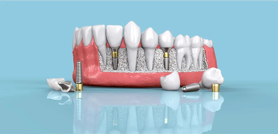 Какие зубные импланты выбрать?