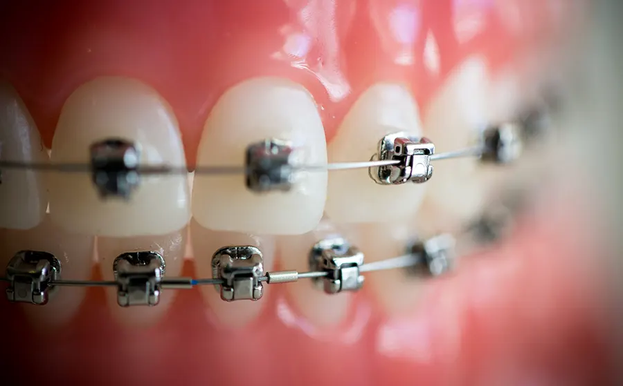 Когда устанавливать ортодонтический аппарат?