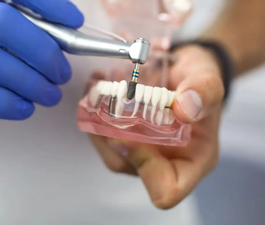 Имплантация зубов во Львове – отличное решение при отсутствии зубов