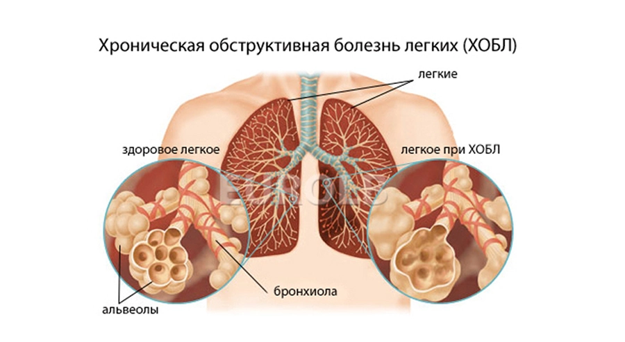 На фото Влияние анемии на течение хронической обструктивной болезни легких