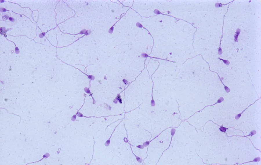 На фото Астенозооспермія у чоловіків: причини та лікування