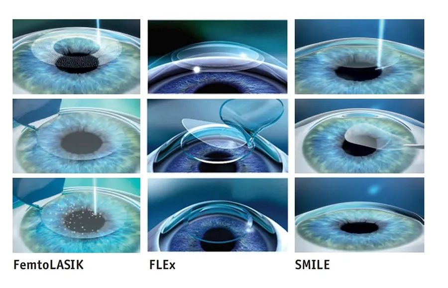 На фото Лазерная коррекция зрения: революционный подход к исправлению зрительных проблем