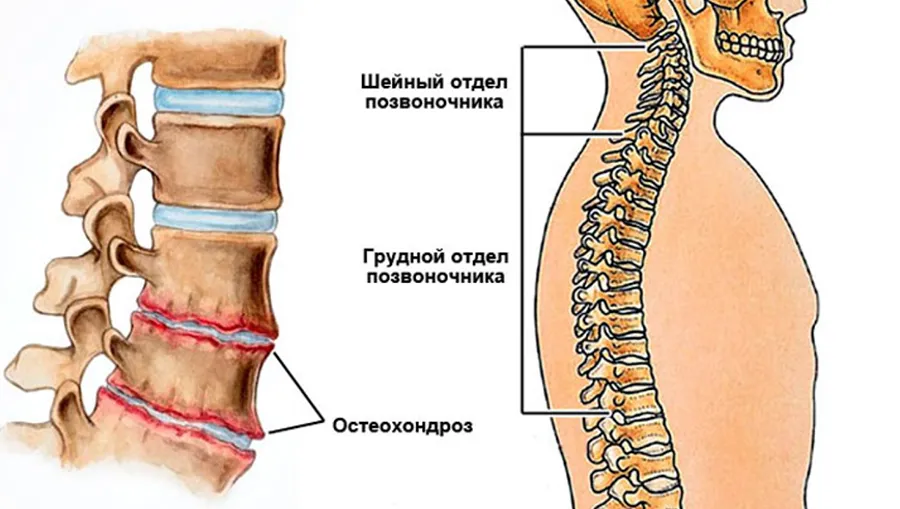 На фото Лечение остеохондроза шейного отдела позвоночника: симптомы, методы и профилактика