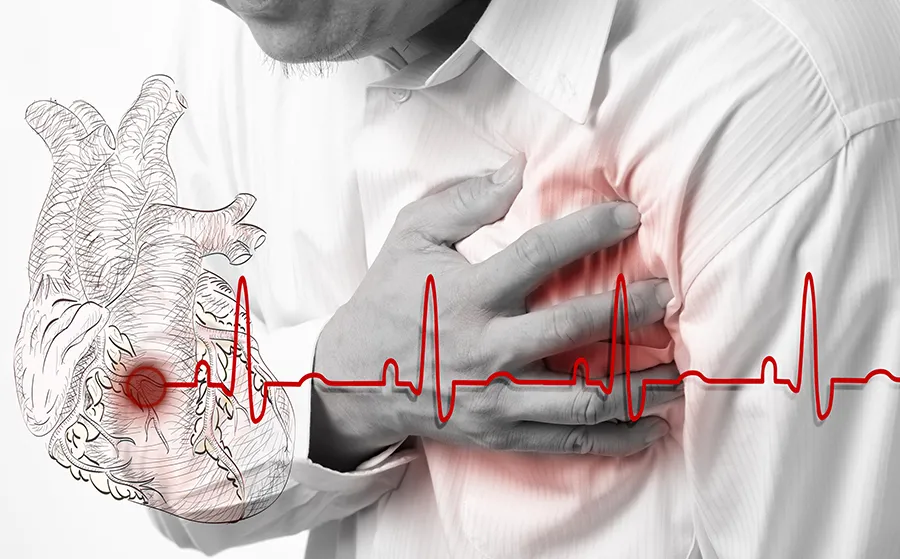 На фото Инфаркт миокарда: смертельная угроза и спасение сердца