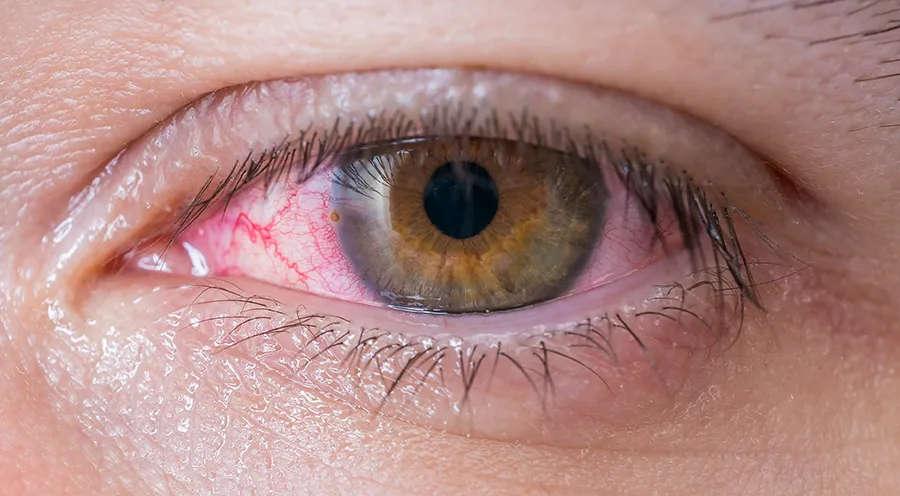 На фото Красные пятна в глазах: причины, симптомы и лечение