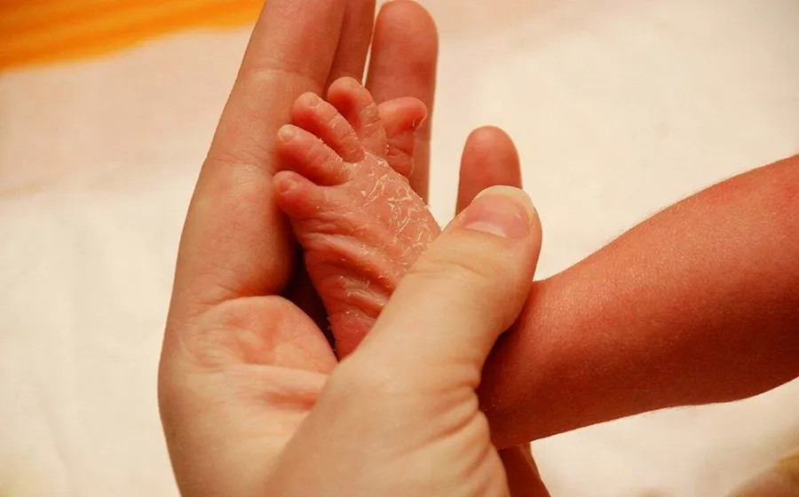 На фото Причины и факторы, способствующие развитию сухой кожи у детей
