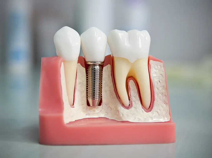 Все о зубных имплантах