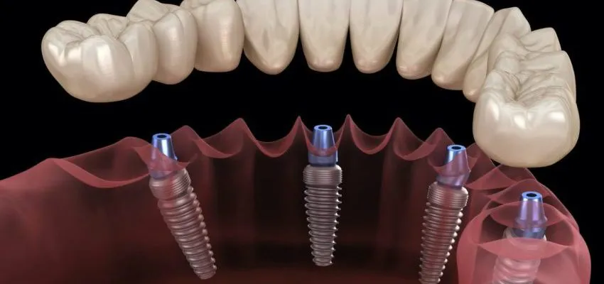На фото Все о зубных имплантах: Основы и преимущества