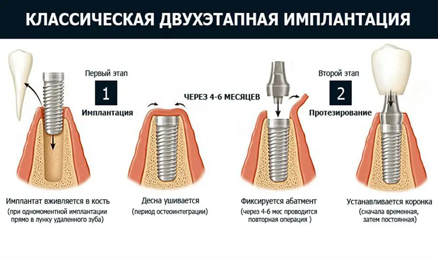 Процесс имплантации зубов