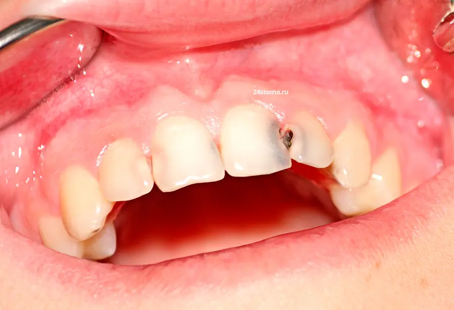 На фото Современные методы лечения межзубного кариеса