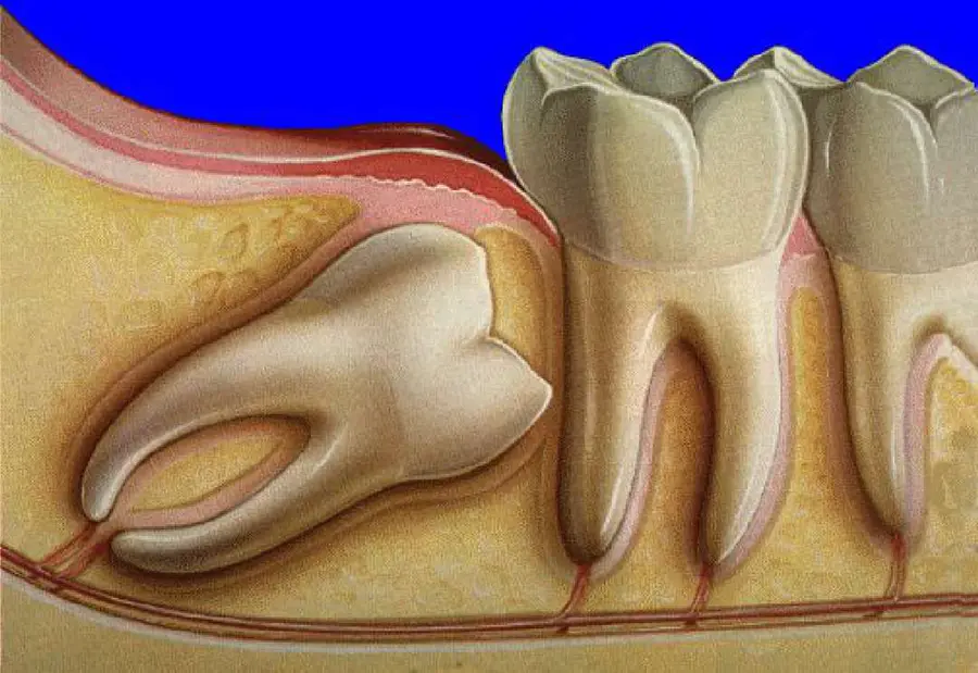 Зубы мудрости