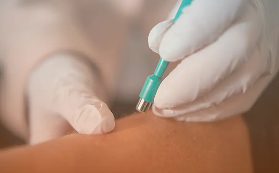 Біопсія шкіри