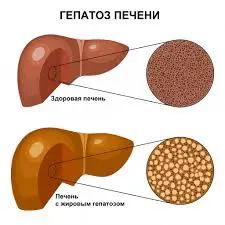 на фото Лечение печеночно-жирового гепатоза в Израиле