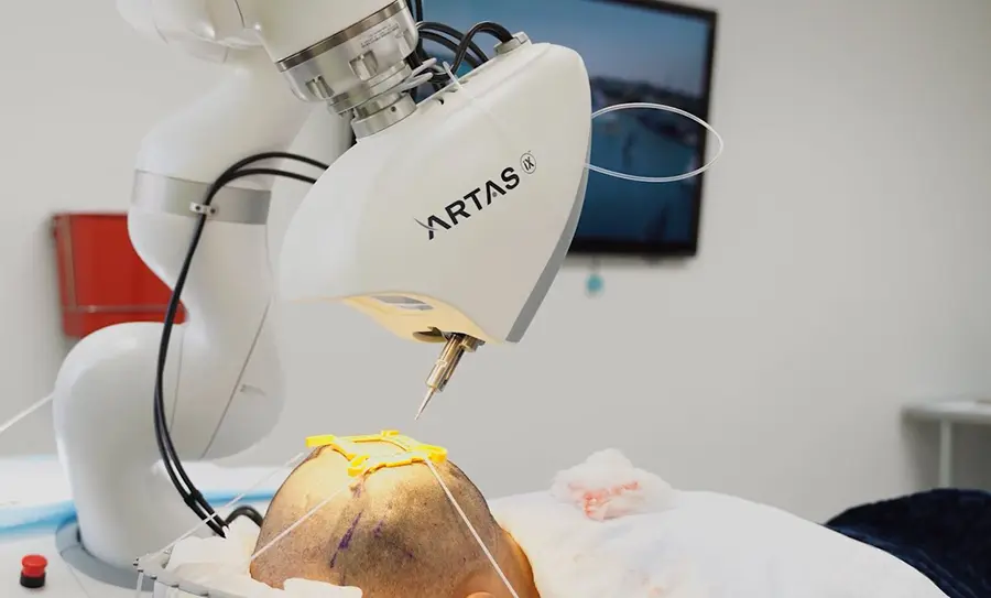 на фото Новий метод пересадки волосся FUE Artas