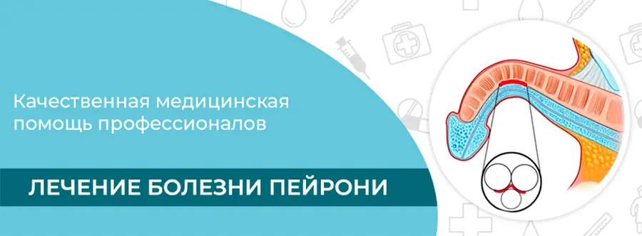 Болезнь Пейрони: лечение, симптомы, диагностика