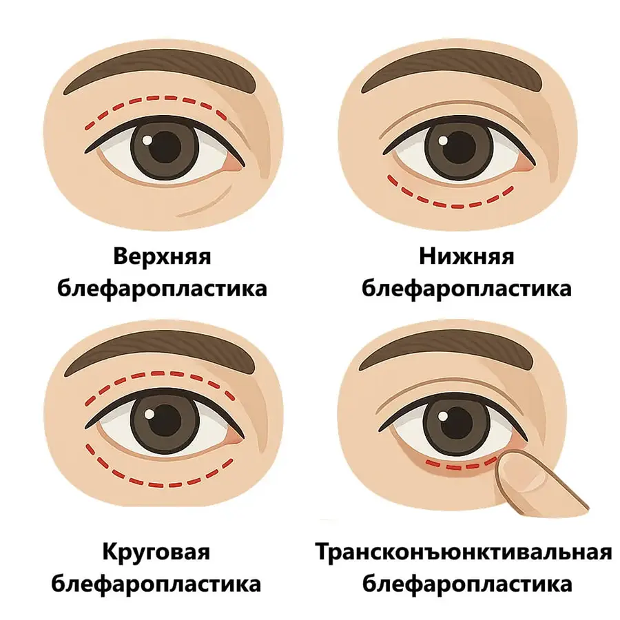 виды блефаропластики